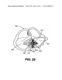 IMPLANTABLE DEVICES FOR CONTROLLING THE SIZE AND SHAPE OF AN ANATOMICAL     STRUCTURE OR LUMEN diagram and image