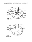 IMPLANTABLE DEVICES FOR CONTROLLING THE SIZE AND SHAPE OF AN ANATOMICAL     STRUCTURE OR LUMEN diagram and image