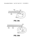 IMPLANTABLE DEVICES FOR CONTROLLING THE SIZE AND SHAPE OF AN ANATOMICAL     STRUCTURE OR LUMEN diagram and image