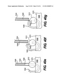 IMPLANTABLE DEVICES FOR CONTROLLING THE SIZE AND SHAPE OF AN ANATOMICAL     STRUCTURE OR LUMEN diagram and image