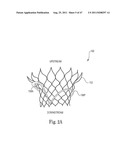 Mitral Prosthesis and Methods for Implantation diagram and image