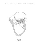 Mitral Prosthesis and Methods for Implantation diagram and image