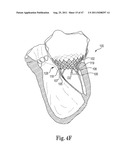 Mitral Prosthesis and Methods for Implantation diagram and image