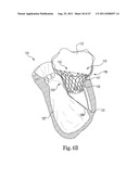 Mitral Prosthesis and Methods for Implantation diagram and image