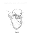 Mitral Prosthesis and Methods for Implantation diagram and image