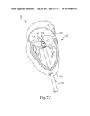 Mitral Prosthesis and Methods for Implantation diagram and image