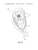 Mitral Prosthesis and Methods for Implantation diagram and image