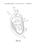 Mitral Prosthesis and Methods for Implantation diagram and image