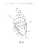 Mitral Prosthesis and Methods for Implantation diagram and image