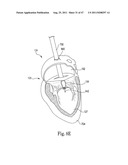 Mitral Prosthesis and Methods for Implantation diagram and image