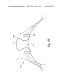 Mitral Prosthesis and Methods for Implantation diagram and image