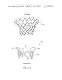 Mitral Prosthesis and Methods for Implantation diagram and image