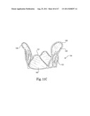 Mitral Prosthesis and Methods for Implantation diagram and image