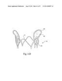 Mitral Prosthesis and Methods for Implantation diagram and image