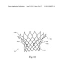 Mitral Prosthesis and Methods for Implantation diagram and image