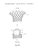 Mitral Prosthesis and Methods for Implantation diagram and image