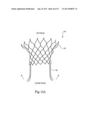 Mitral Prosthesis and Methods for Implantation diagram and image