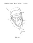 Mitral Prosthesis and Methods for Implantation diagram and image