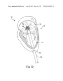 Mitral Prosthesis and Methods for Implantation diagram and image