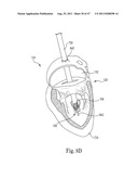 Mitral Prosthesis and Methods for Implantation diagram and image