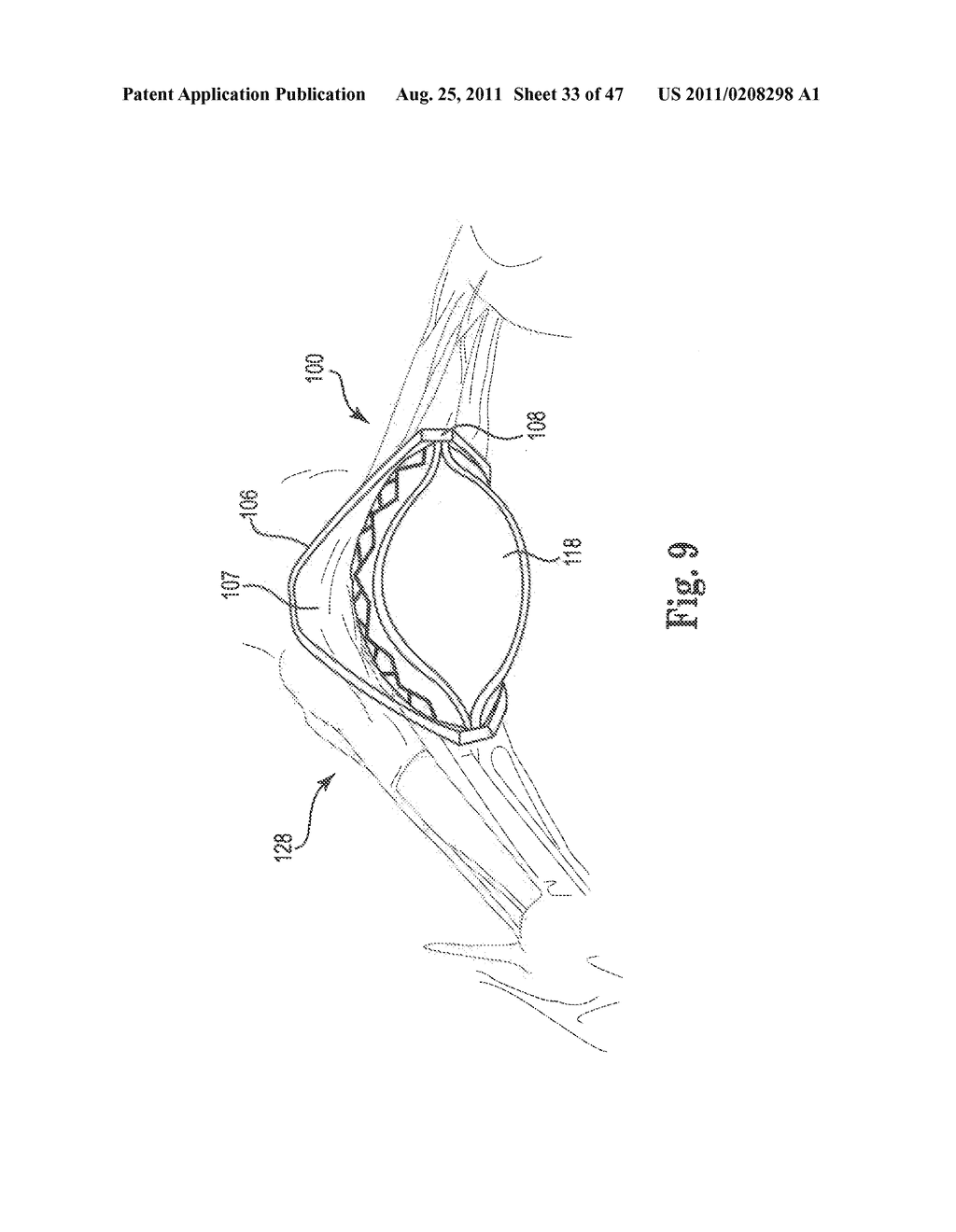 Mitral Prosthesis and Methods for Implantation - diagram, schematic, and image 34