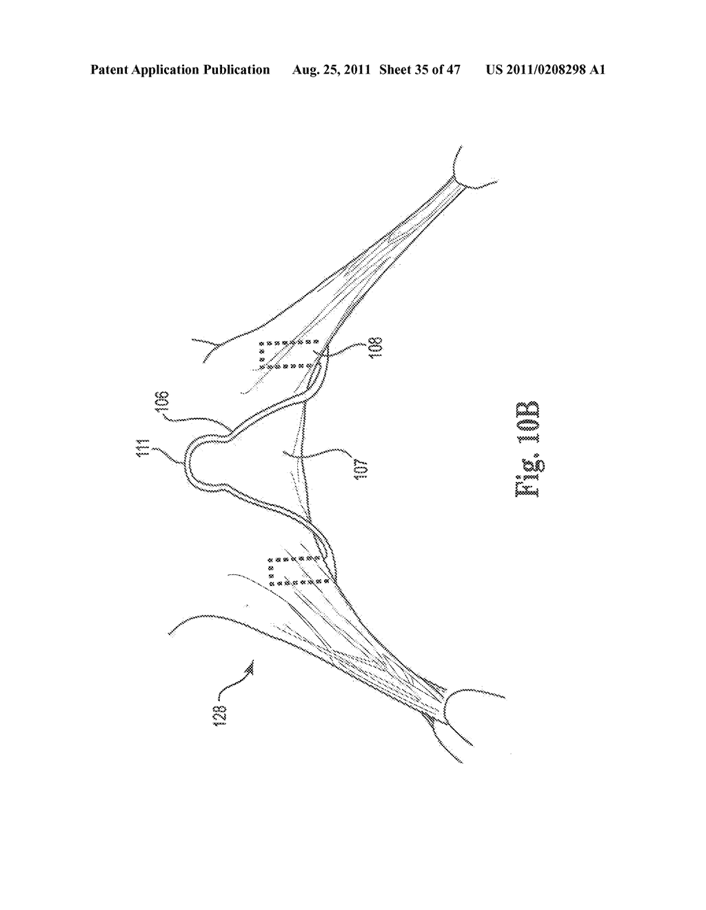 Mitral Prosthesis and Methods for Implantation - diagram, schematic, and image 36