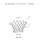 Mitral Prosthesis and Methods for Implantation diagram and image