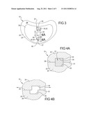 LATENT MOBILE BEARING FOR PROSTHETIC DEVICE diagram and image