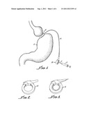 IMPLANTABLE ACCESS PORT DEVICE AND ATTACHMENT SYSTEM diagram and image