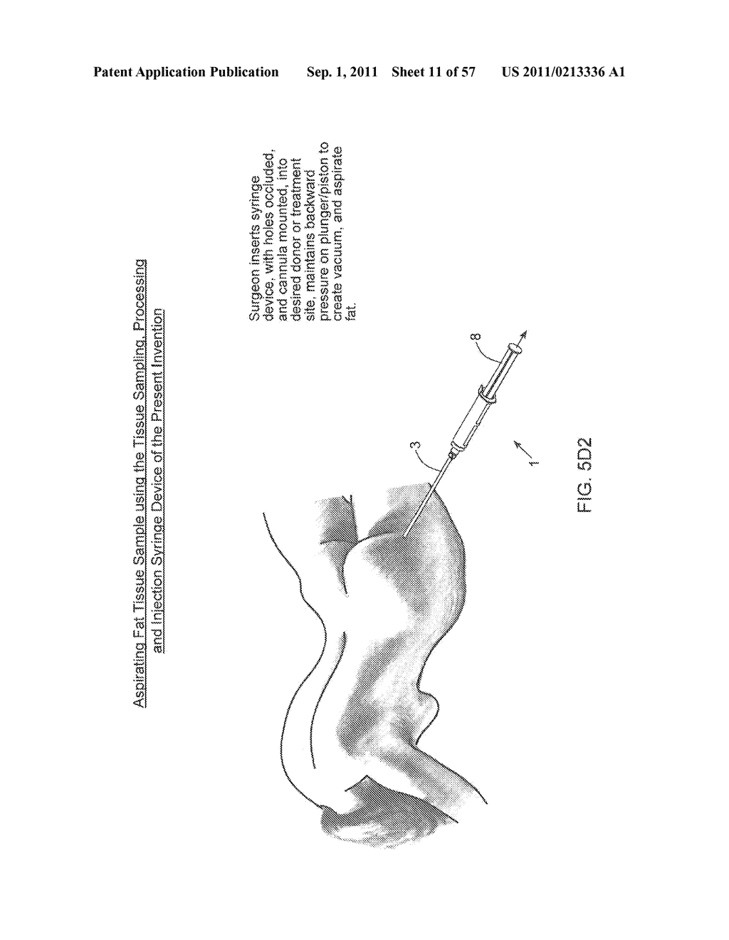 METHOD OF AND APPARATUS FOR SAMPLING, PROCESSING AND COLLECTING TISSUE AND     REINJECTING THE SAME INTO HUMAN PATIENTS - diagram, schematic, and image 12