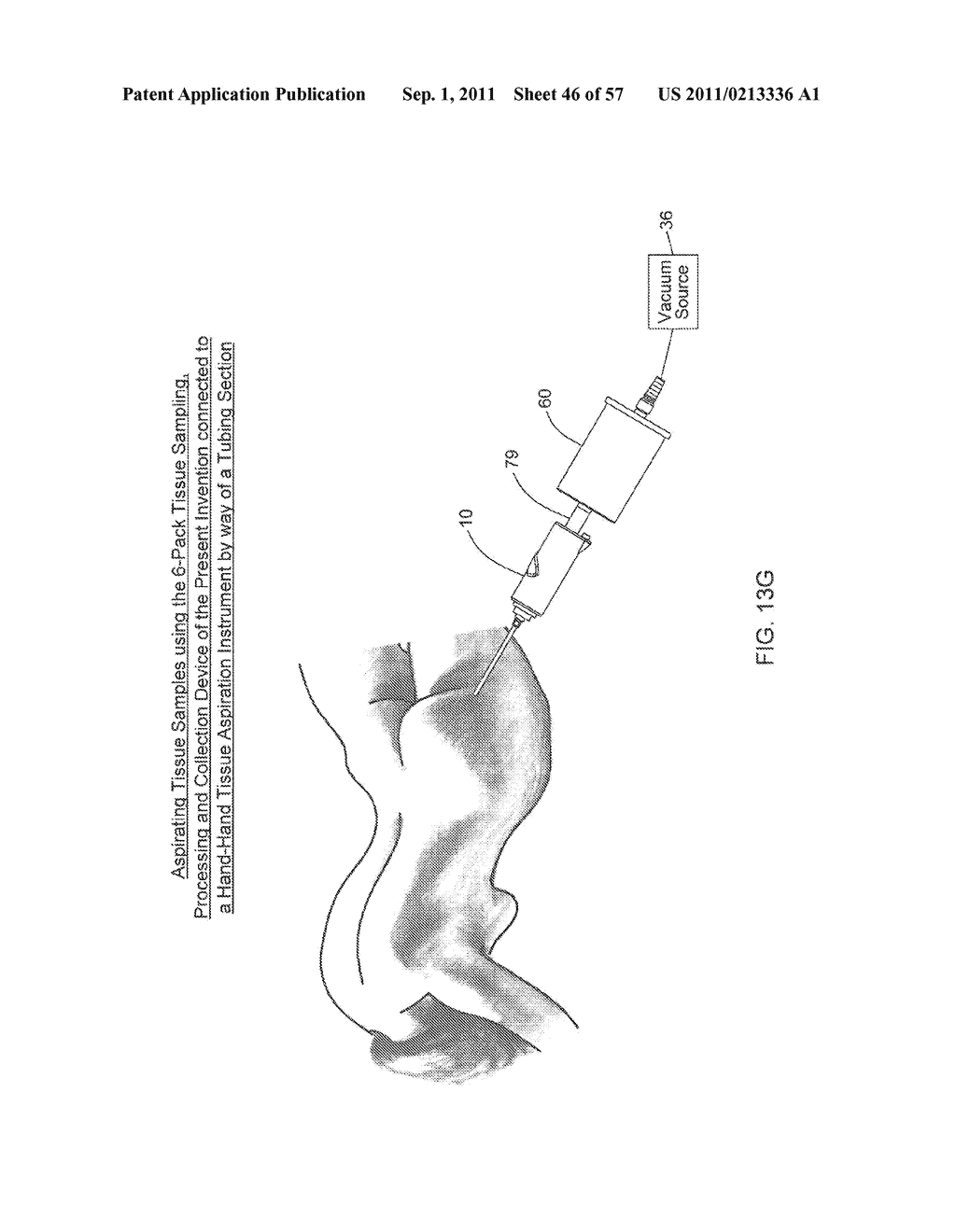 METHOD OF AND APPARATUS FOR SAMPLING, PROCESSING AND COLLECTING TISSUE AND     REINJECTING THE SAME INTO HUMAN PATIENTS - diagram, schematic, and image 47