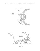 Real-time Virtual Indicium Apparatus and Methods for Guiding an Implant     into an Eye diagram and image