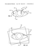 Real-time Virtual Indicium Apparatus and Methods for Guiding an Implant     into an Eye diagram and image