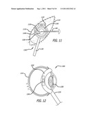Real-time Virtual Indicium Apparatus and Methods for Guiding an Implant     into an Eye diagram and image