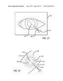 Real-time Virtual Indicium Apparatus and Methods for Guiding an Implant     into an Eye diagram and image