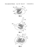 Tissue Ablation System With Internal And External Radiation Sources diagram and image