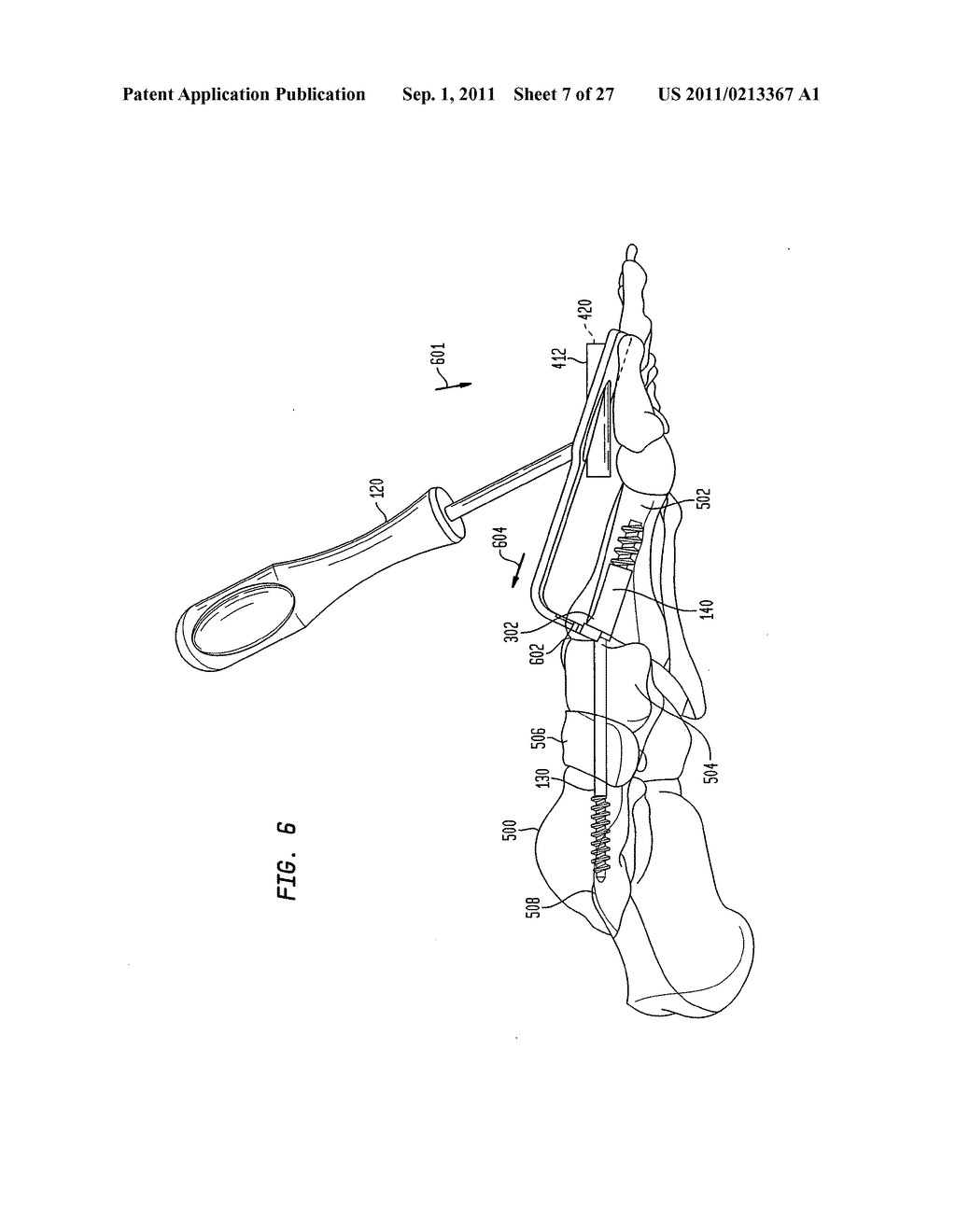 INTRAMEDULLARY FIXATION SCREW, A FIXATION SYSTEM, AND METHOD OF FIXATION     OF THE SUBTALAR JOINT - diagram, schematic, and image 08