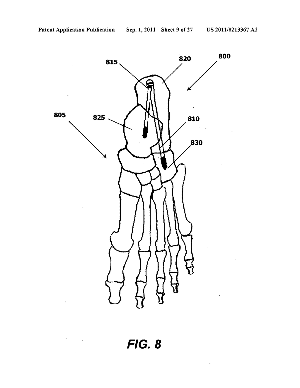 INTRAMEDULLARY FIXATION SCREW, A FIXATION SYSTEM, AND METHOD OF FIXATION     OF THE SUBTALAR JOINT - diagram, schematic, and image 10