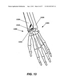 INTRAMEDULLARY FIXATION SCREW, A FIXATION SYSTEM, AND METHOD OF FIXATION     OF THE SUBTALAR JOINT diagram and image