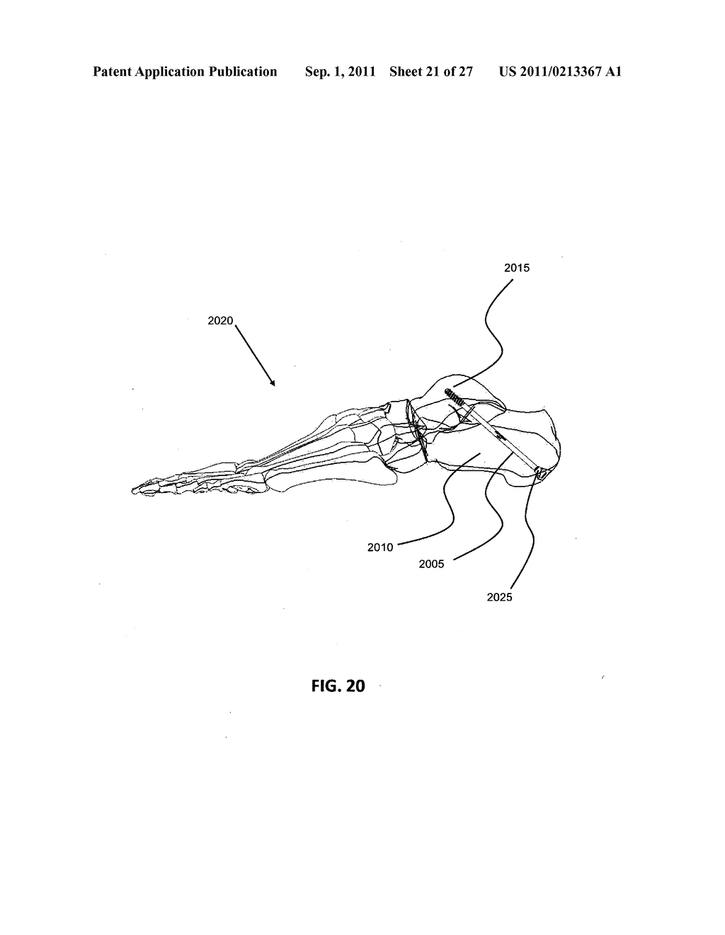 INTRAMEDULLARY FIXATION SCREW, A FIXATION SYSTEM, AND METHOD OF FIXATION     OF THE SUBTALAR JOINT - diagram, schematic, and image 22