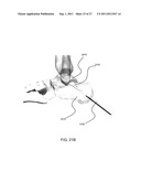 INTRAMEDULLARY FIXATION SCREW, A FIXATION SYSTEM, AND METHOD OF FIXATION     OF THE SUBTALAR JOINT diagram and image