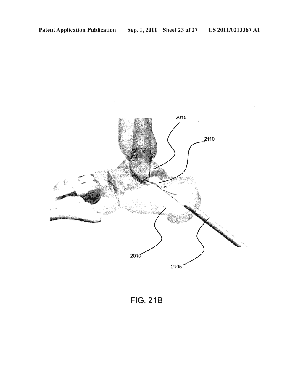 INTRAMEDULLARY FIXATION SCREW, A FIXATION SYSTEM, AND METHOD OF FIXATION     OF THE SUBTALAR JOINT - diagram, schematic, and image 24