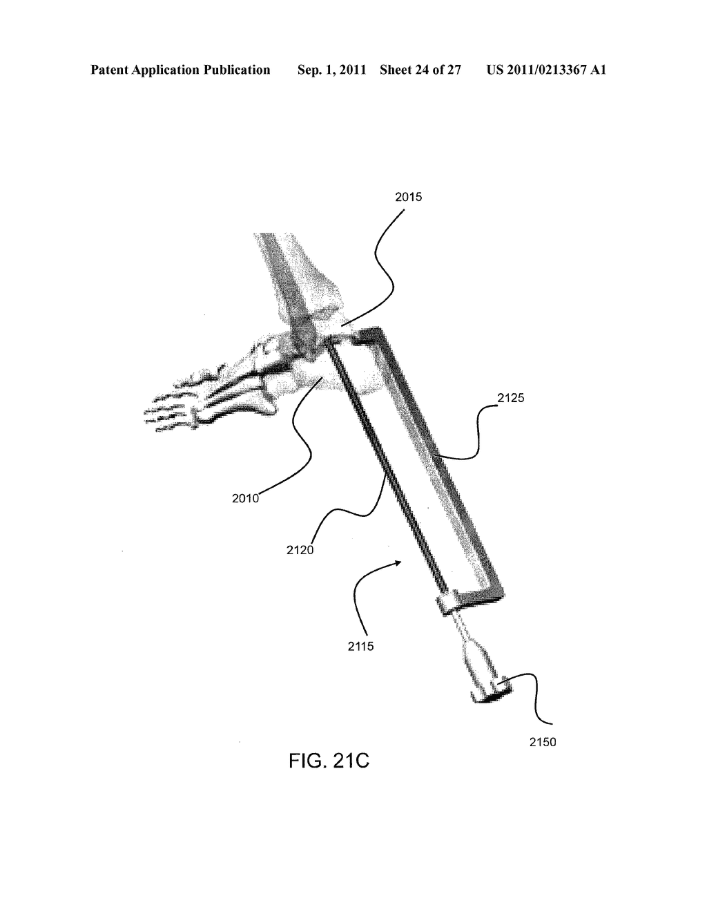 INTRAMEDULLARY FIXATION SCREW, A FIXATION SYSTEM, AND METHOD OF FIXATION     OF THE SUBTALAR JOINT - diagram, schematic, and image 25