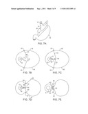 DELIVERY SYSTEMS AND METHODS FOR GASTRIC REDUCTION diagram and image