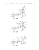 DELIVERY SYSTEMS AND METHODS FOR GASTRIC REDUCTION diagram and image