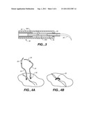 Minimally Invasive Valve Repair Procedure and Apparatus diagram and image