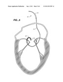 Minimally Invasive Valve Repair Procedure and Apparatus diagram and image