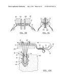 Adjustable Knotless Loops diagram and image