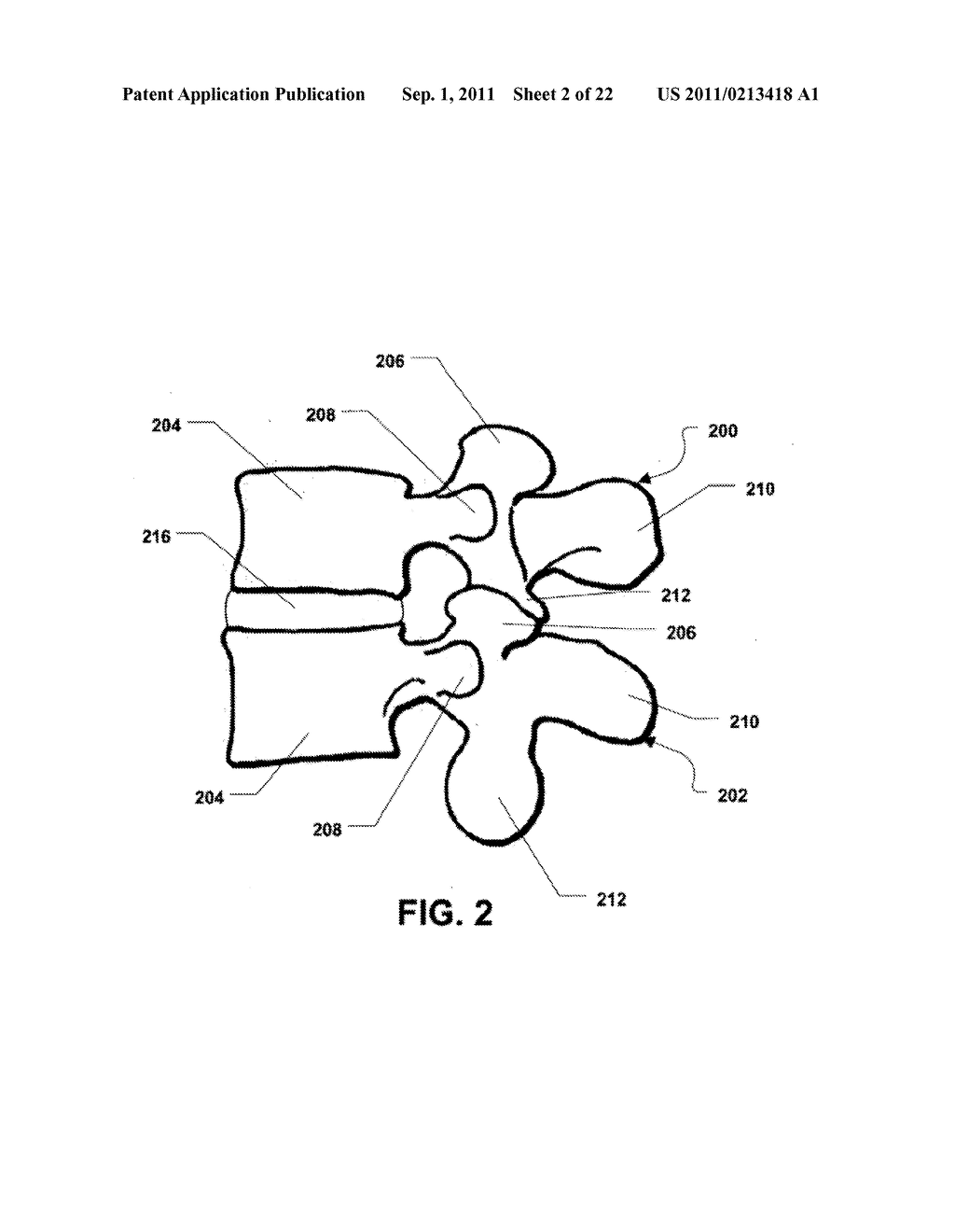 MULTI-CHAMBER EXPANDABLE INTERSPINOUS PROCESS SPACER - diagram, schematic, and image 03