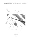 ORTHOPEDIC FIXATION ASSEMBLY AND METHOD OF USE diagram and image